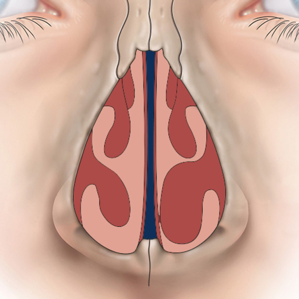 Turbinate hypertrophy