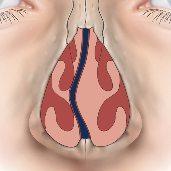 Deviated nasal septum